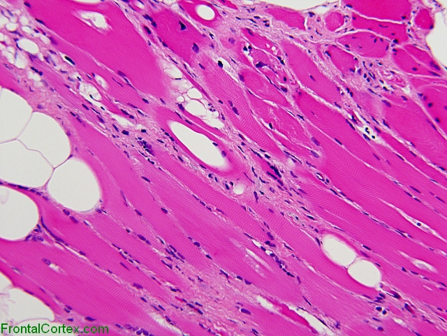 Titinopathy, paraffin-embedded H&E stained section of muscle x 200